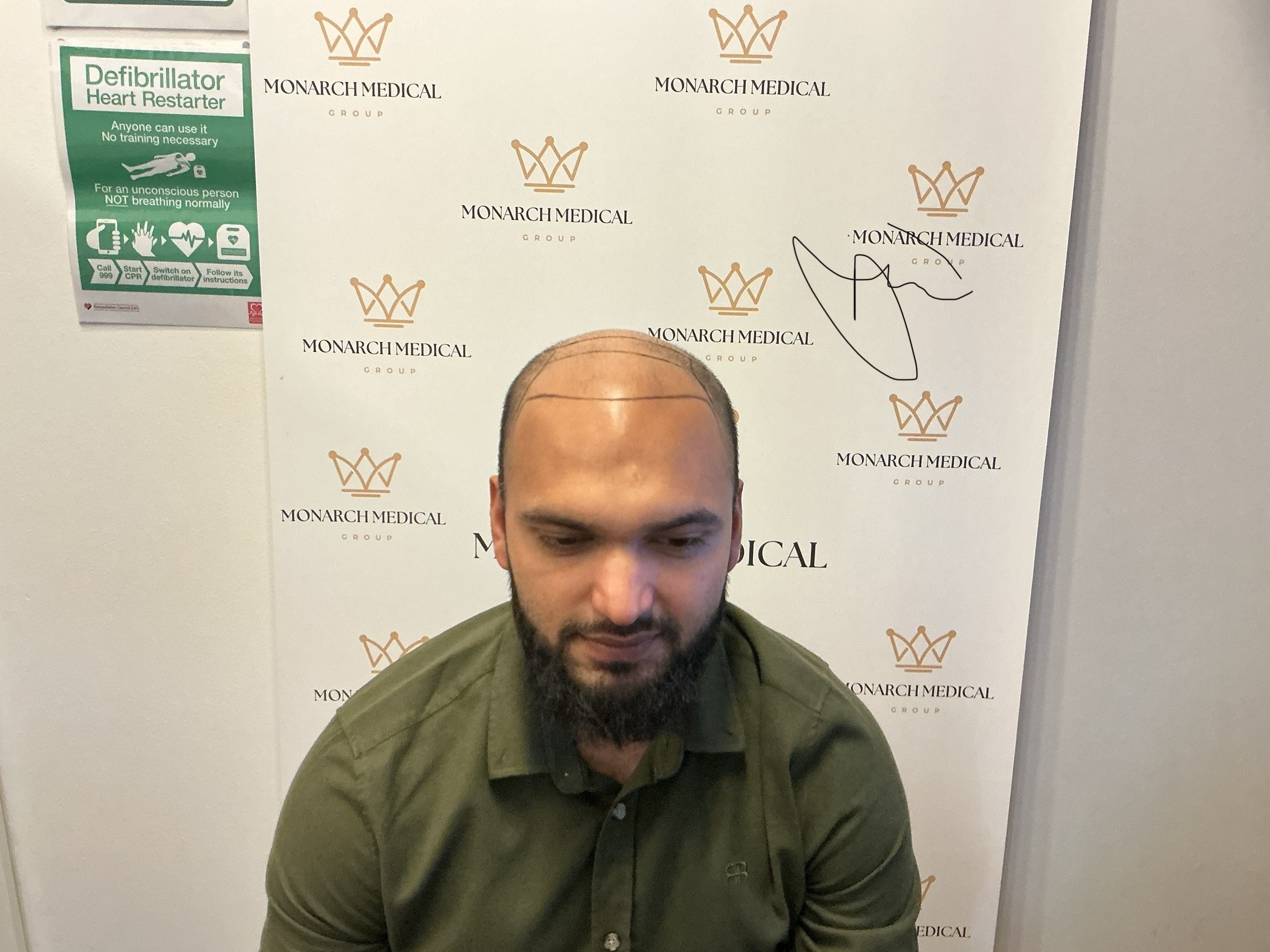 Hussain Norwood 7 hair transplant 6-month results Chester